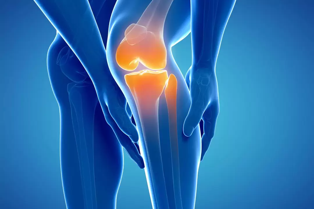 Αρθροπάθεια της άρθρωσης του γόνατος (γονάρθρωση, παραμορφωτική οστεοαρθρίτιδα)